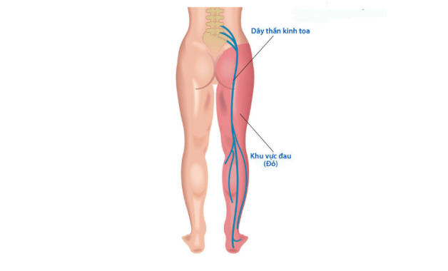 Chữa Đau Thần Kinh Tọa