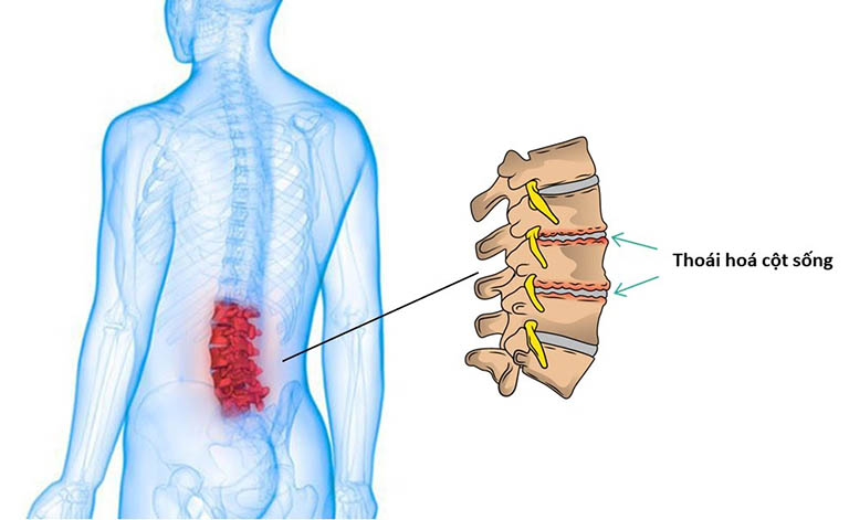 Chữa Bệnh thoái hóa cột sống lưng, cổ